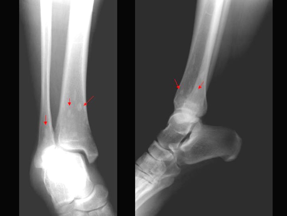 <p>common benign sclerotic bone lesions</p>