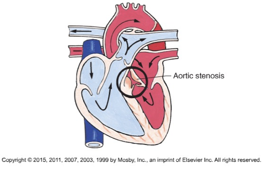 <p>Aortic valve narrowing</p><p>blood black flow will be before the stenosis (left ventricle will be weaker)</p>
