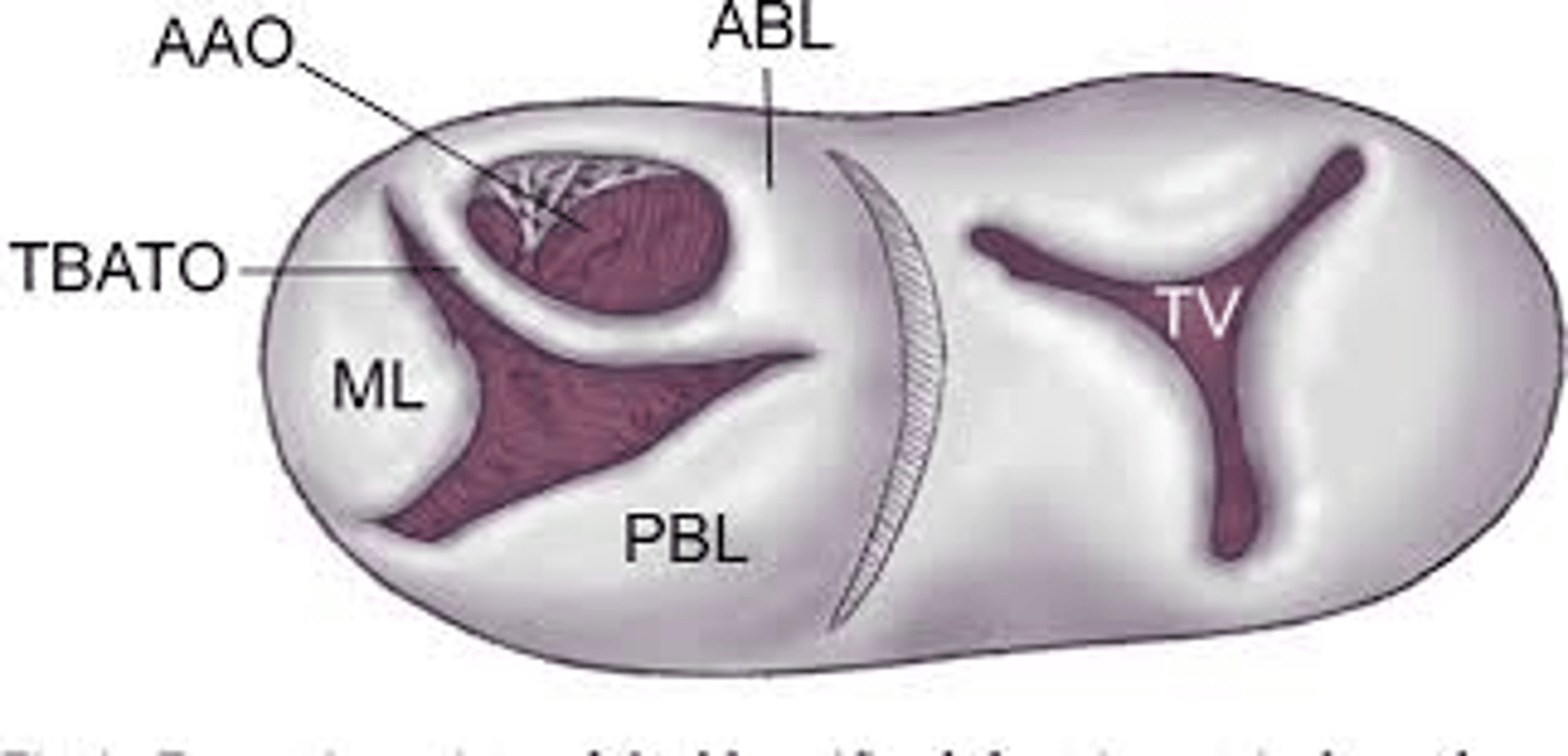 <p>complicated 5% of all cases of AV septal defect.</p><p>In most cases the accessory cleft can be closed and treat it as an uncomplicated AV septal defect.</p><p>The accessory cleft is not a part of the original leaflets so bridging the tissues by dividing between isn't feasible.</p>