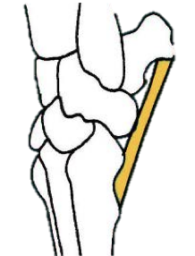 <p>Tendons of the foreleg muscles attach to the accessory carpal bone, allowing the bone to act as a sort of lever for FLEXION of the carpus</p><ul><li><p>However, when animals are standing, the legs are in extension</p></li><li><p>To prevent hyperextension, the<strong> PALMAR LIGAMENT</strong> attaches to the distal portion of the accessory carpal bone, inserting at the METACARPALS to stabilize it </p></li></ul><p></p>