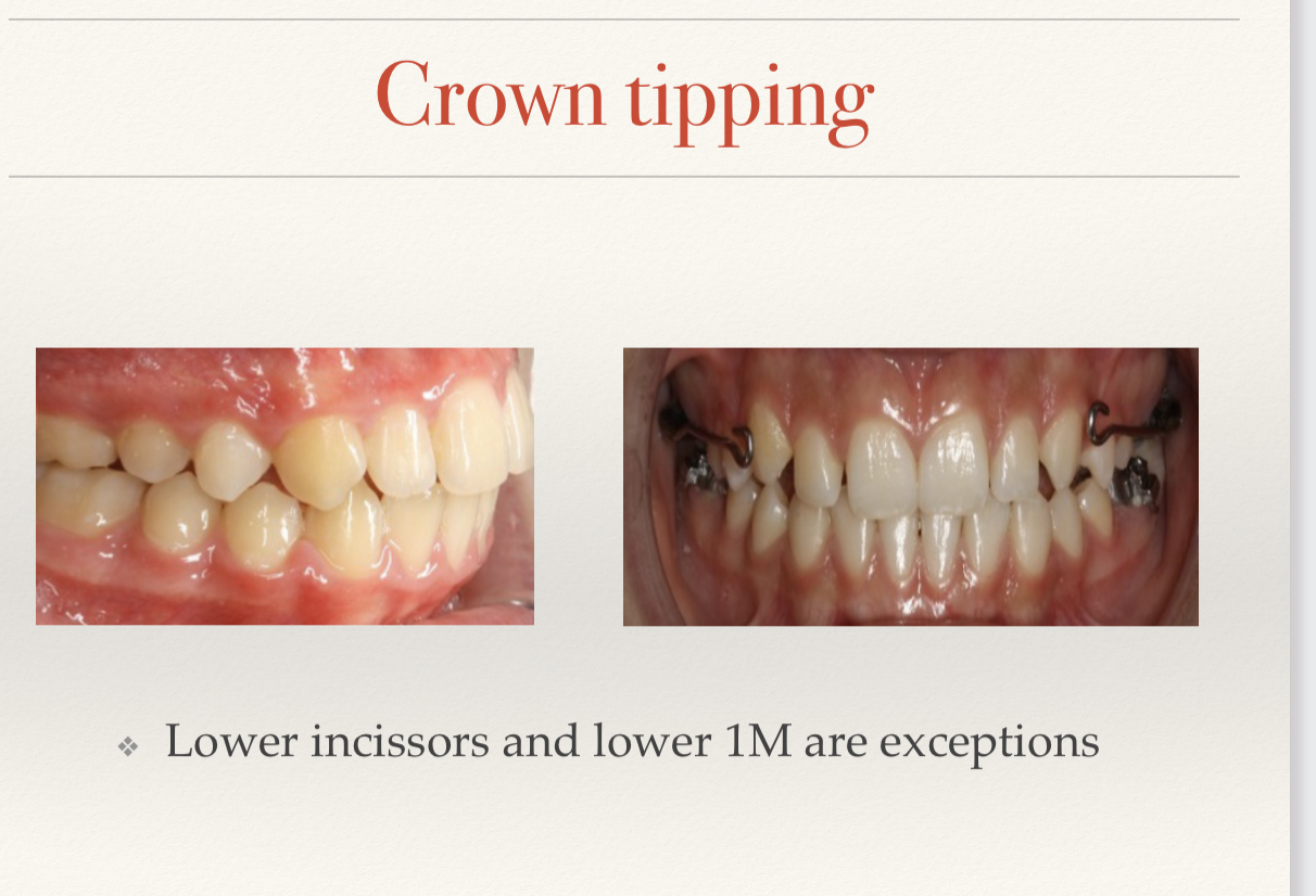 <p><span style="font-size: calc(var(--scale-factor)*17.00px);"><span>❖ </span></span><span style="font-size: calc(var(--scale-factor)*28.00px);"><span>Crown angulation or TIP OF THE CROWN</span></span><br><span style="font-size: calc(var(--scale-factor)*17.00px);"><span>❖ </span></span><span style="font-size: calc(var(--scale-factor)*28.00px);"><span>Refers to the long axis of the crown ≠ long axis of the root</span></span><br><span style="font-size: calc(var(--scale-factor)*17.00px);"><span>❖ </span></span><span style="font-size: calc(var(--scale-factor)*28.00px);"><span>The gingival portion of each crown should be distal to the incisal</span></span><br><span style="font-size: calc(var(--scale-factor)*28.00px);"><span>portion.</span></span></p><p><span style="font-size: calc(var(--scale-factor)*17.00px);"><span>❖ </span></span><span style="font-size: calc(var(--scale-factor)*28.00px);"><span>Crown angulation or TIP OF THE CROWN</span></span><br><span style="font-size: calc(var(--scale-factor)*17.00px);"><span>❖ </span></span><span style="font-size: calc(var(--scale-factor)*28.00px);"><span>Refers to the long axis of the crown ≠ long axis of the root</span></span><br><span style="font-size: calc(var(--scale-factor)*17.00px);"><span>❖ </span></span><span style="font-size: calc(var(--scale-factor)*28.00px);"><span>The degree of the crown tip is the angle between the long axis of the</span></span><br><span style="font-size: calc(var(--scale-factor)*28.00px);"><span>crown seen from a labial surface and a line bearing 90º from the</span></span><br><span style="font-size: calc(var(--scale-factor)*28.00px);"><span>occlusal plane.</span></span><br><span style="font-size: calc(var(--scale-factor)*17.00px);"><span>❖ </span></span><span style="font-size: calc(var(--scale-factor)*28.00px);"><span>The gingival portion of each crown should be distal to the incisal</span></span><br><span style="font-size: calc(var(--scale-factor)*28.00px);"><span>portion.</span></span><br><span style="font-size: calc(var(--scale-factor)*17.00px);"><span>❖ </span></span><span style="font-size: calc(var(--scale-factor)*28.00px);"><span>The angulation varies according to tooth type.</span></span></p>