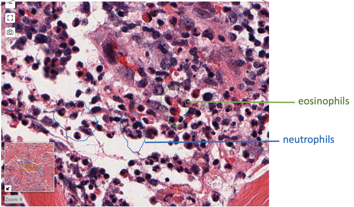 <p>this means acute inflammation!</p>