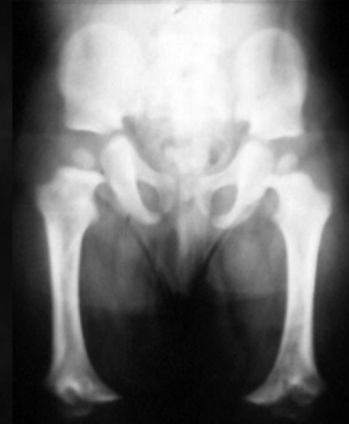 <p>what is seen here for this case of achondroplasia?</p>