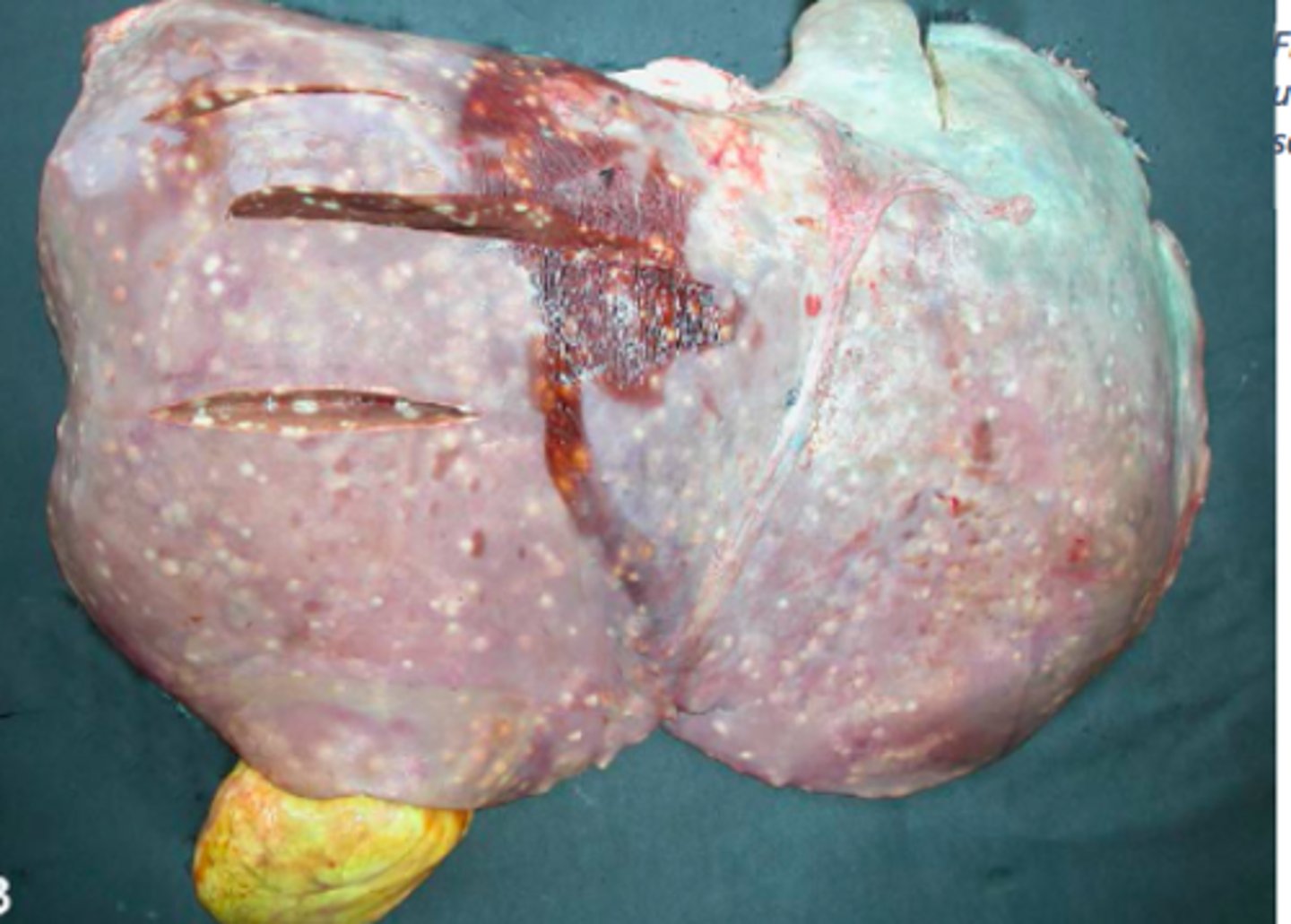 <p>Lever fra kvæg, hvad er den patoanatomiske diagnose og patogensen?</p>