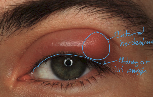 <ul><li><p>Inflamed meibomain gland</p></li><li><p>Tenderness over inflamed meibomian gland</p></li><li><p>calor</p></li><li><p>overlying hyperemia</p></li></ul><p></p>