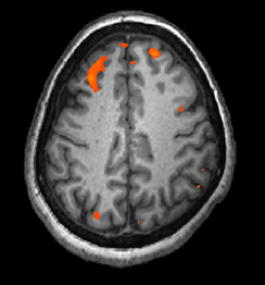 <p><span>Like an MRI but also shows changes in brain activity over time by tracking blood flow and oxygen levels; provides more detailed images of the brain’s structure and better accuracy in time than PET scans </span></p>