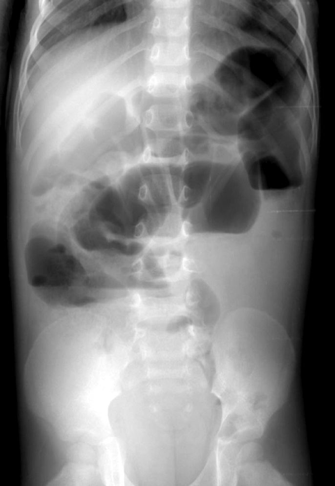 <p>intestinal obstruction</p>