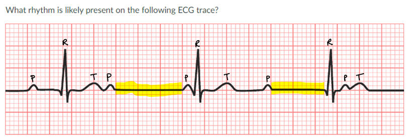 <p>JONES IN CLASS ASSIGNMENT QUESTIONS:</p><p>a. second degree heart block</p><p>b. complete heart block</p><p>c. sinus tachycardia</p><p>d. Long QT syndrome</p>