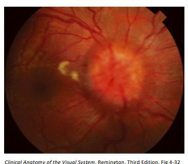<p>Papilledema is defined as <strong>optic disk edema secondary to elevated intracranial pressure.</strong></p><ul><li><p>Bilateral!</p></li></ul><p>Should<strong> not be used to denote to disc edema. </strong>(if monocular, just optic edema)</p><p>It is unclear whether the visual loss associated with chronic papilledema results from <strong>disturbances of axonal transport</strong>, <strong>or </strong>from<strong> ischemia due to congestion </strong>of the optic nerve head.</p>