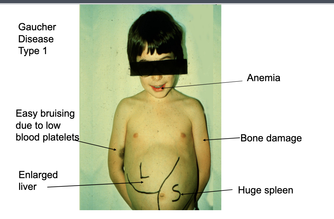 <ul><li><p>anemia</p></li><li><p>easy bruising due to <strong>low blood platelets</strong></p></li><li><p>bone damage</p></li><li><p>enlarged liver</p></li><li><p>huge spleen</p></li></ul><p></p>
