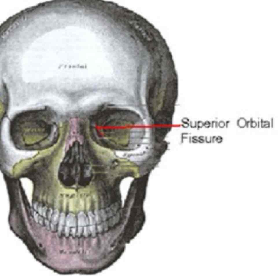 <p>cat #3 / narrow slit-like opening / fissure in skull</p>