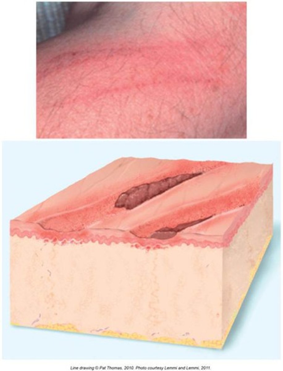 <p>Loss of epidermis, linear hollowed out and crusted area</p><p>Examples can include cat scratches</p>