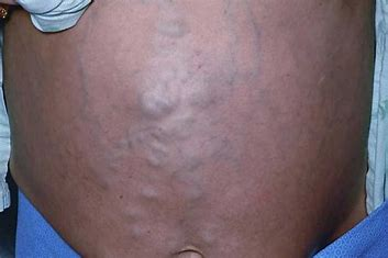 <p>= prominent, dilated epigastric veins that occur with portal HTN, cirrhosis, ascites, or venal cava obstruction</p><ul><li><p>ABNORMAL</p></li></ul>