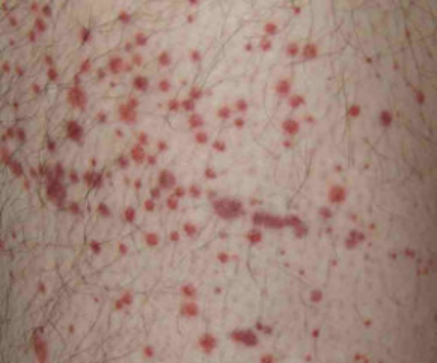 <p>Petechia</p>