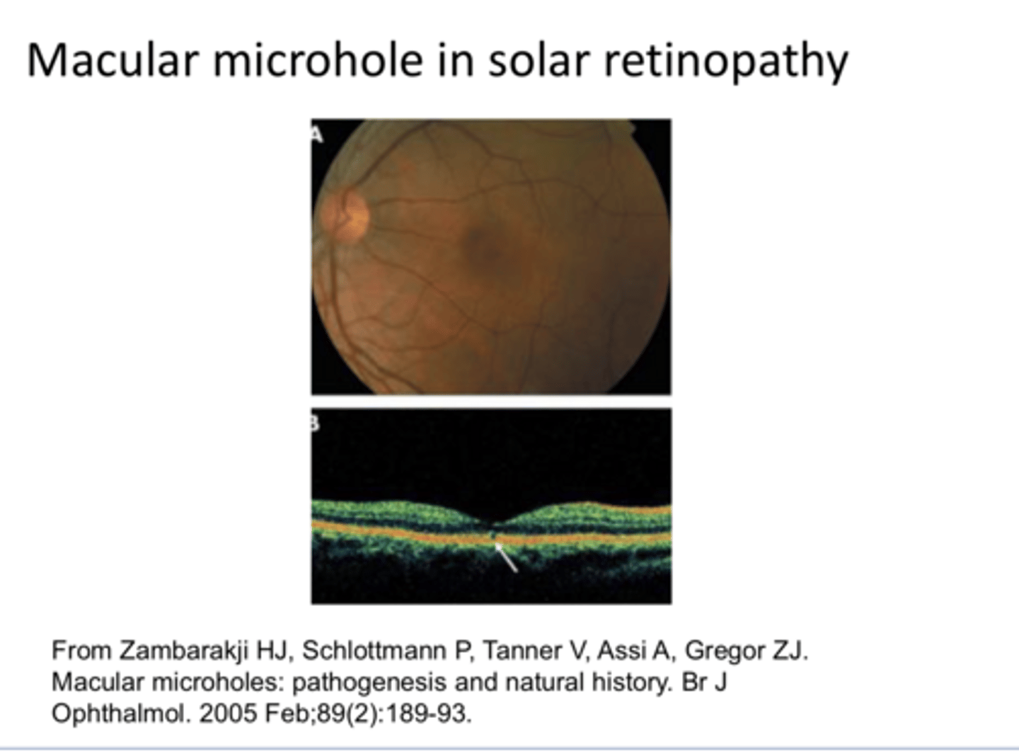 <p>True or False: </p><p>Visual disruption from solar retinopathy can remain or recover over weeks to months</p>