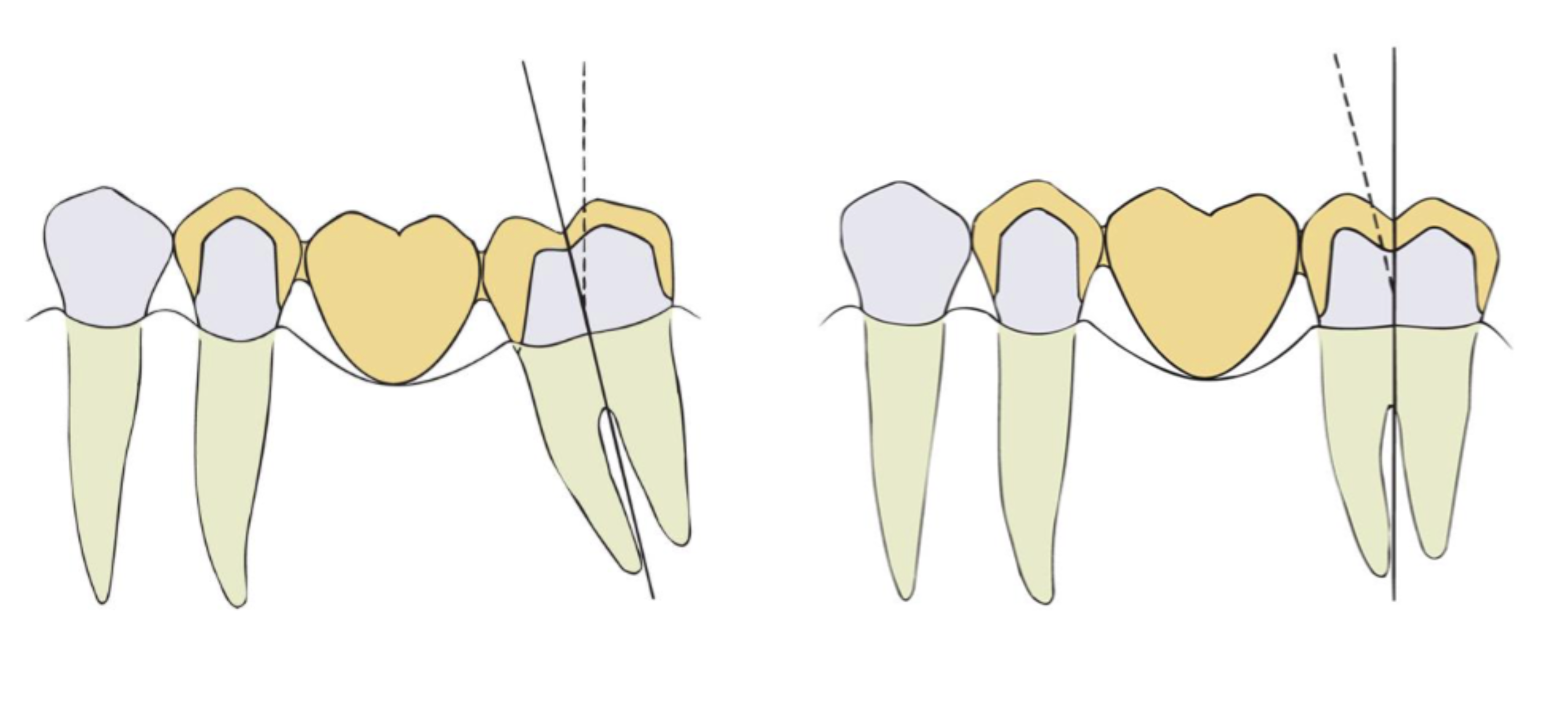 <p>ortho repositioning can help the crown prep be more conservative </p>