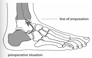 <ul><li><p><span style="color: red;">Vertical resection of calcaneus <em>rotated 90 degrees</em> then arthrodesis to distal tibia</span></p></li></ul><ul><li><p><span style="color: red;">Allows end weight bearing without a prosthesis</span></p></li></ul><p></p>