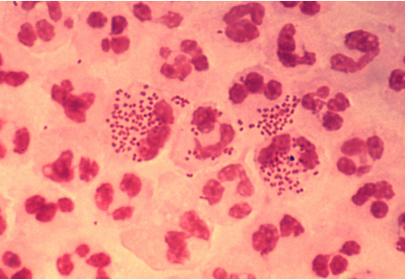 <p>STI caused by Neisseria gonorrhoeae</p><p><u>Complications </u>(F): PID, infertility, neonatal infections</p><p><u>Signs</u>:</p><ul><li><p>Heavy yellow/white/ green purulent discharge</p></li><li><p>Burning sensation while urinating</p></li><li><p>Painful/ swollen testicles or vulva</p></li><li><p>Swollen glands/ burning in throat</p></li><li><p>Bleeding between periods or after intercourse</p></li><li><p>Conjuctivitis (neonates as well)</p></li></ul><p><u>Diagnosis</u>:</p><ul><li><p>Microscopy and culture of swabs from pus secretions: intracellular gram-ve diplococci and oxidase +ve</p></li></ul><p><u>Treatment</u>: ceftriaxone 250mg and azithromycin 1g</p><p></p>