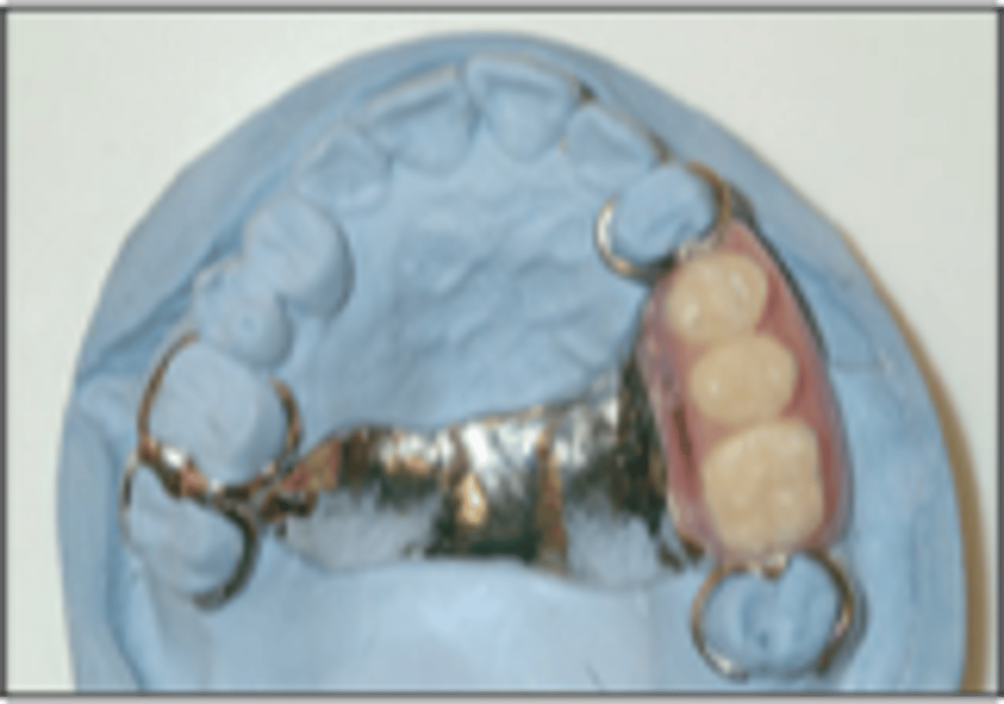 <p>Biomechanical classification in which support comes from teeth</p>