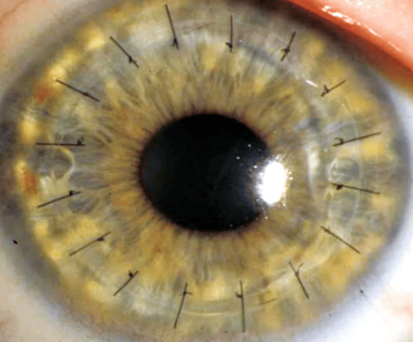 <p>How can we manage/tweak astigmatism after PKP with interrupted sutures (more common)?</p>