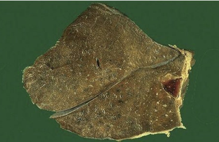 <p><span>1. Identify the condition. <br>2. Describe the morphology? <br>3. Mention two possible clinical findings in such a case? <br></span></p>