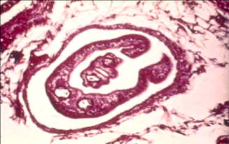 <p>in human tissue section</p><p>cercarial dermatitis, eosinophilia</p><p>history of long term water exposure</p><p>Africa, Middle East, South America, Caribbean, East Asia, Asia Pacific</p>
