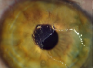 <p>Erosio corneae recidivans</p>