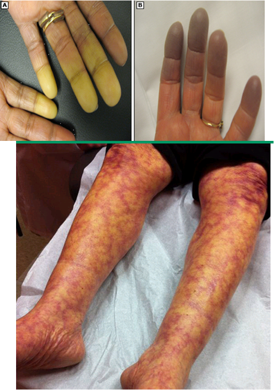 <p><strong>periungual erythema:</strong> dilated tortuous loops of caps and prominent sub cap venous plexus along base of nail</p><p><strong>livedo reticularis: </strong>reddish-cyanotic, reticular pattern on skin- arms, legs, torso (exacerbated by cold temps)</p><p><strong>Raynaud phenomenon:</strong> vasospastic process of fingers/toes → blanching</p><p><strong>vasculitis:</strong> urticarial vasculitis → painful petechial or purpura that may heal w/ hyperpigmentation </p>