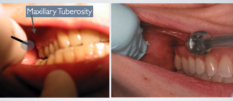 <p>mucogingival junction of maxillary 2nd or 3rd molar</p>