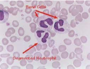 <p>What type of smear cell and what conditions is it seen in</p>