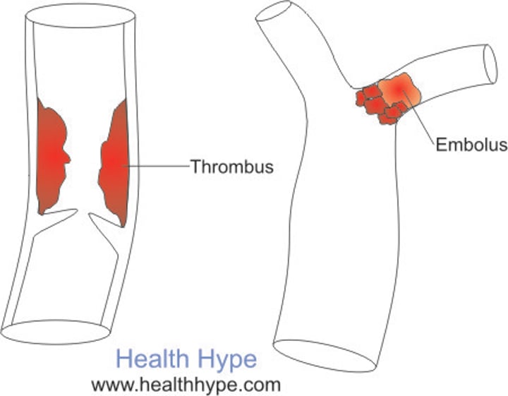 <p>fixed clot that develops and persists in an unbroken blood vessel</p>