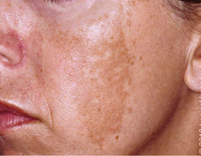 <p>light/dark brown hyperpigmentation that occurs in sun exposed areas; symmetric; pigmentation evolves rapidly</p><p>most commonly on the face</p>