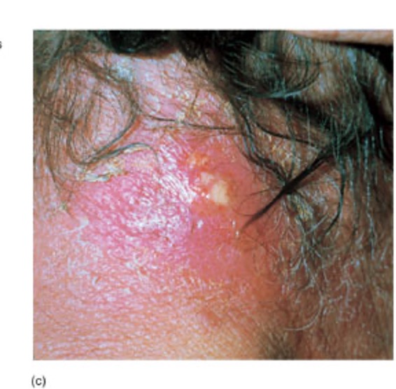 <p>multiple interconnected furuncles; </p><p>I&amp;D + <strong>abx</strong> w/ activity against s. aureus (same as furuncle)</p>