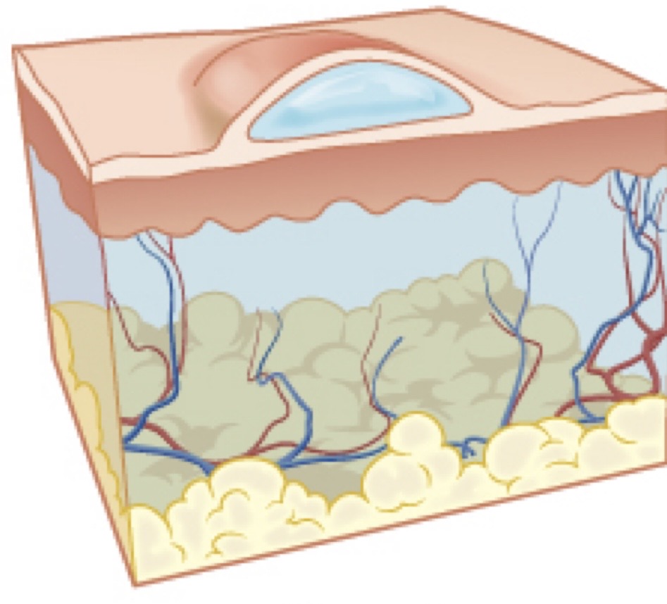 <p>Swollen, inflamed areas of skin that often itch or burn</p><p>Usually from an allergic reaction</p>