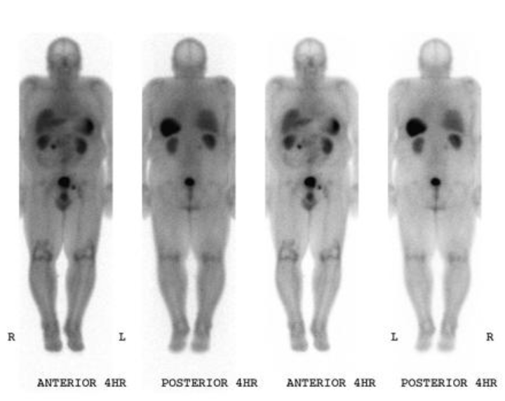 <p>What type of imaging detects NET (75% sensitivity) by measuring octreotide (somatostatin mimic) uptake?</p>