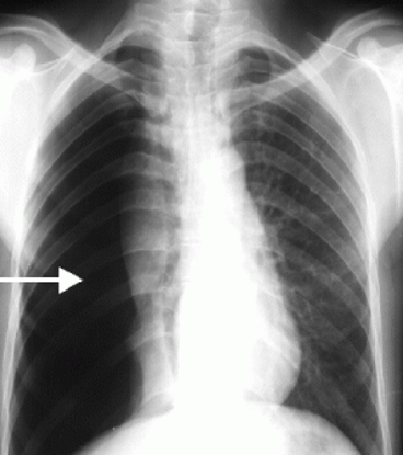<p>Pneumothorax</p>