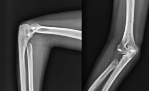 <p>Indications for radial head excision includes substantial fracture of radial head but UCL Intact, why?</p>