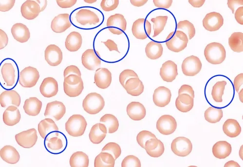 <p><span>Schistocytes</span></p>