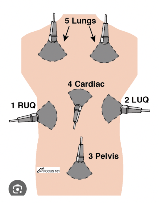 <p>A bedside U/S that is used to identify free fluid - used for blunt/penetrating chest trauma, trauma in preg, pediatric trauma, undifferentiated hypotension, undifferentiated abd pain</p>