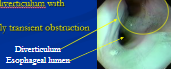 <p><span style="background-color: transparent;">Esophageal Diverticulum</span></p>