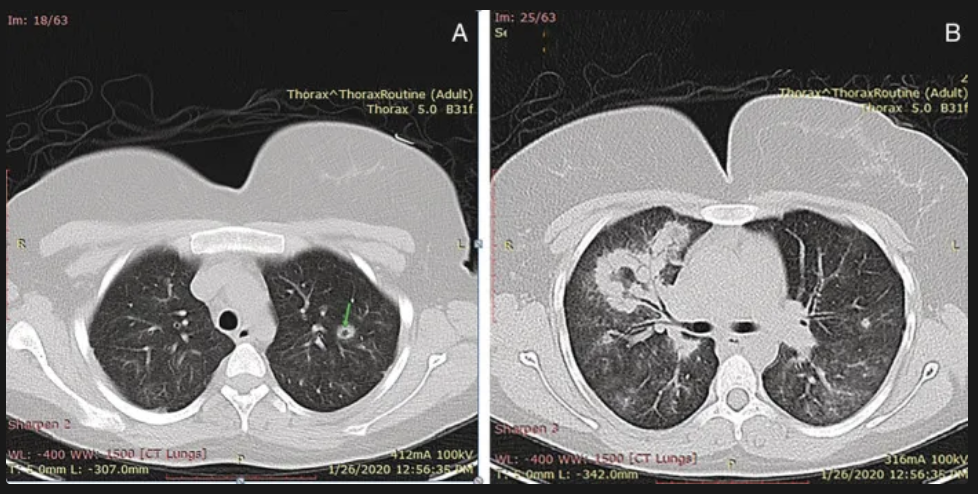 <ul><li><p>Rx de torax:</p><ul><li><p>nódulos e infiltrado pesistentes, a veces cavidades</p></li></ul></li><li><p>Biopsia de tejido afectado:</p><ul><li><p>Inflamación de vasos pequeños (vasculitis), granulomas caseosos</p></li></ul></li><li><p>Biopsia renal:</p><ul><li><p>Glomerulonefritis segmentaria necrotizante sin depósitos inmunitarios .</p></li></ul></li></ul><p></p>
