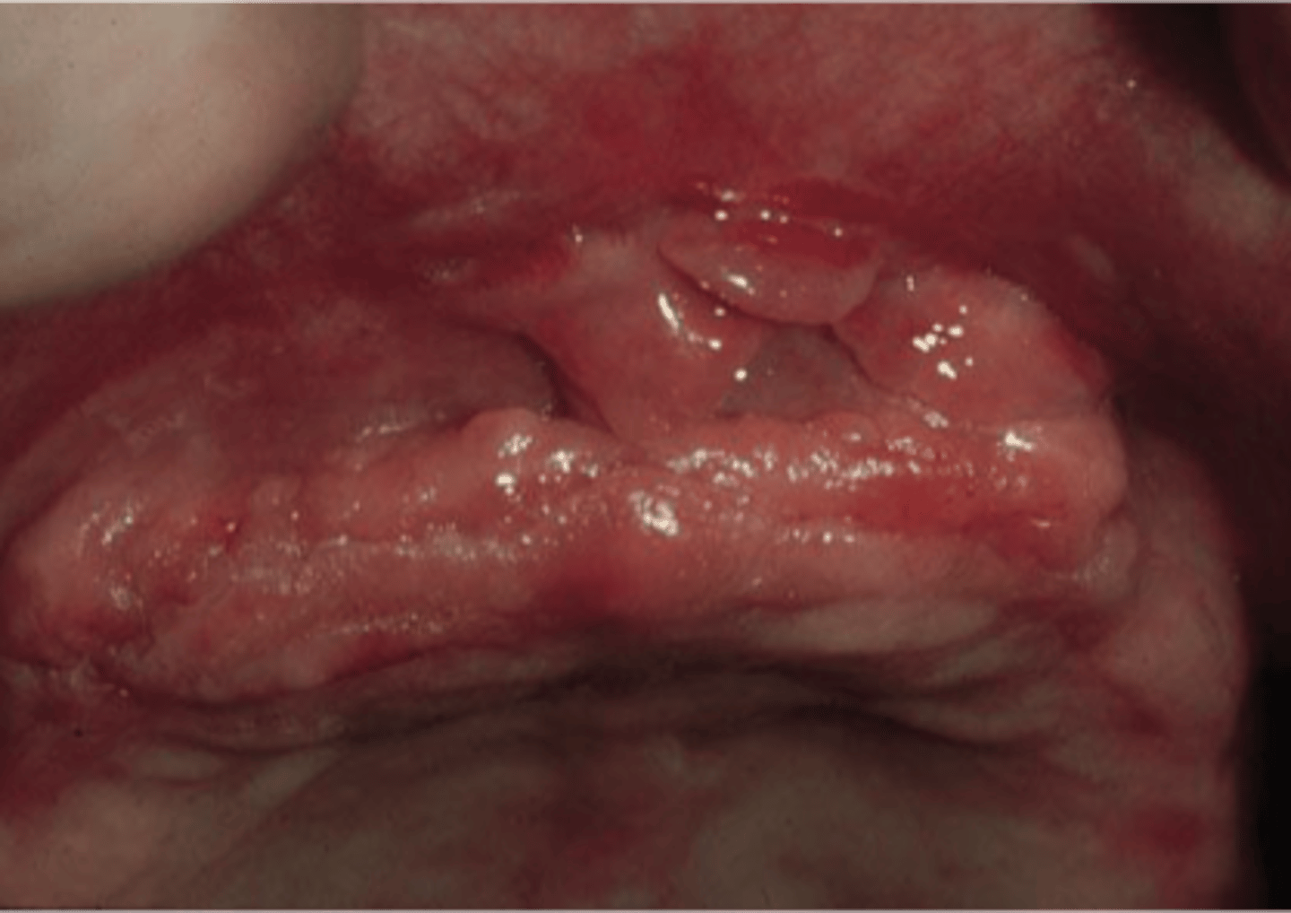 <p>inflammatory fibrous hyperplasia</p>