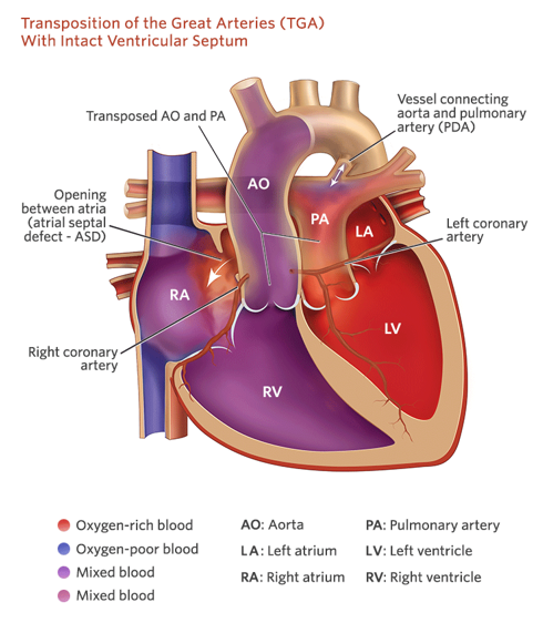 <p><strong><u>Mixed</u> Defect</strong></p><ul><li><p class="">Pulmonary artery and aorta are switched.</p></li><li><p class="">May also have ASD or VSD.</p></li><li><p class=""><strong>Treatment</strong>:</p><ul><li><p class=""><em>Surgical switch*</em></p></li><li><p class="">Balloon atrial septostomy</p></li><li><p class="">Prostaglandins (PGE)</p></li></ul></li></ul><p><strong><u>****Just to need to know that the great vessels need to be surgically switched****</u></strong></p>