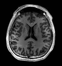 <p>MRI</p>