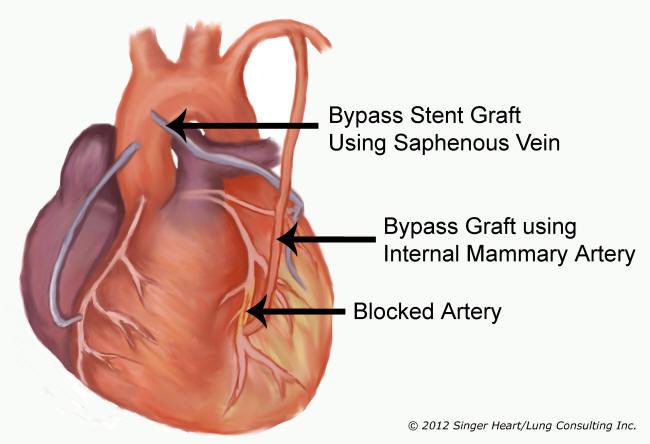<p>Myocardial infarction</p>