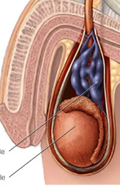 <p>= dilated, totuous internal spermatic vericose veins caused by incompetent valves, which permit reflux of blood</p>