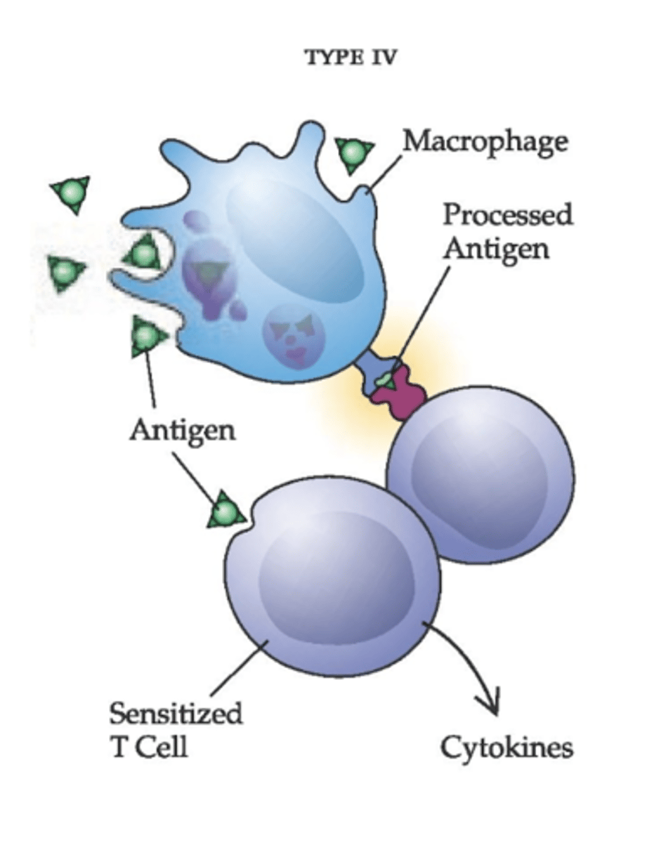 <p>Only one mediated by the sensitized T lymphocytes and macrophages</p><p>causes inflammatory reaction produced by lymphokines, neutrophils, and macrophages (no hives, fever, etc) </p><p>EX: contact dermatitis - hygienists can get a reaction from gloves from certain companies</p>