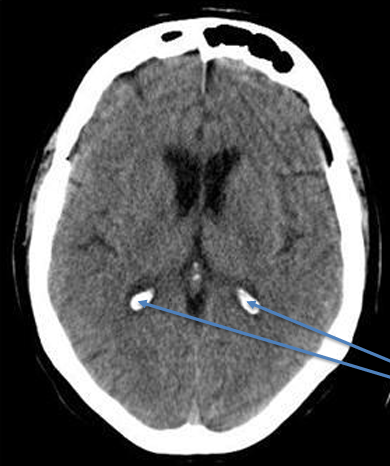 <p>intracranial hematoma, tumor, or calcification</p>