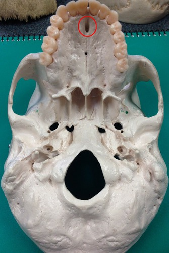 <p>Large bilateral opening located posterior to the central incisor tooth of the maxilla and piercing the hard palate; transmits the nasopalatine arteries and blood vessels</p>