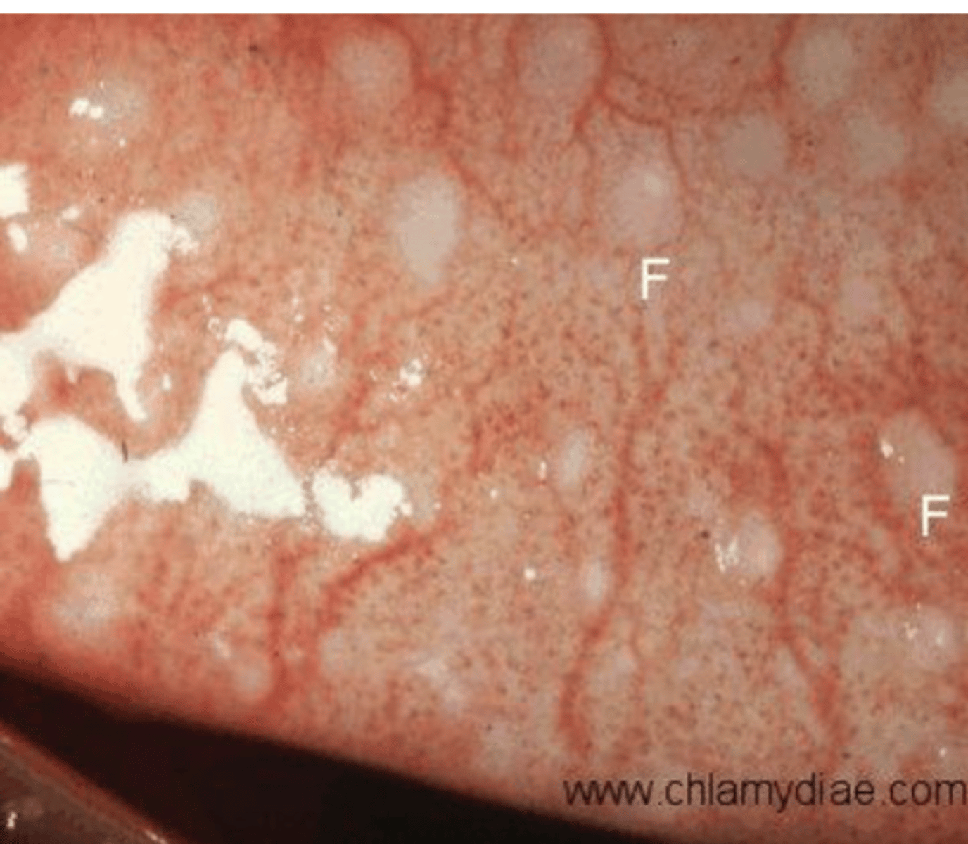 <p>What is the hyperplasia of the lymphoid tissue; blood vessels will circle each follicle; looks like a grain of "grain of rice" below the conjunctiva</p>